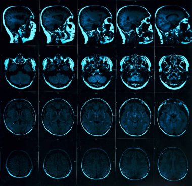 Kafatası ile beyin manyetik rezonans taraması. Mr kafa koyu arka plan mavi renk üzerinde inceden inceye gözden geçirmek. X-ışını tıp ve ilaç kavramı