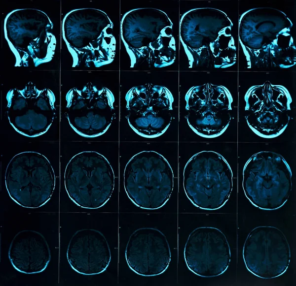 Magnetic resonance scan of the brain with skull. MRI head scan on dark background blue color. X-ray medicine and medication concept