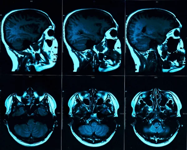 Magnetic resonance scan of the brain with skull. MRI head scan on dark background blue color. X-ray medicine and medication concept