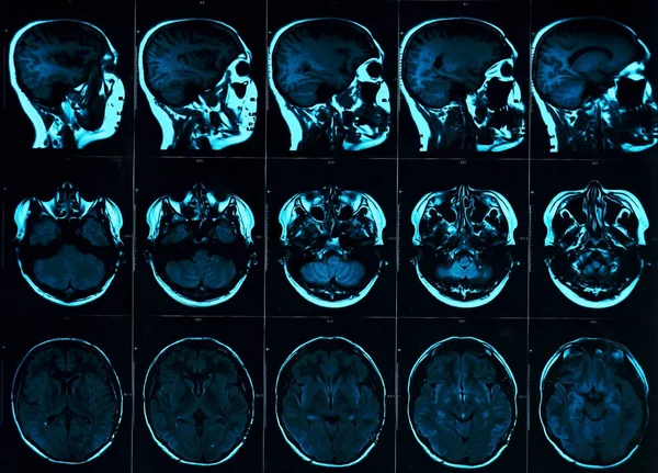 Kafatası ile beyin manyetik rezonans taraması. Mr kafa koyu arka plan mavi renk üzerinde inceden inceye gözden geçirmek. X-ışını tıp ve ilaç kavramı
