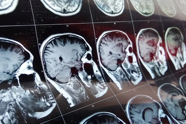 Magnetic resonance scan of the brain with skull. MRI head scan on dark background gray color. X-ray medicine and medication concept