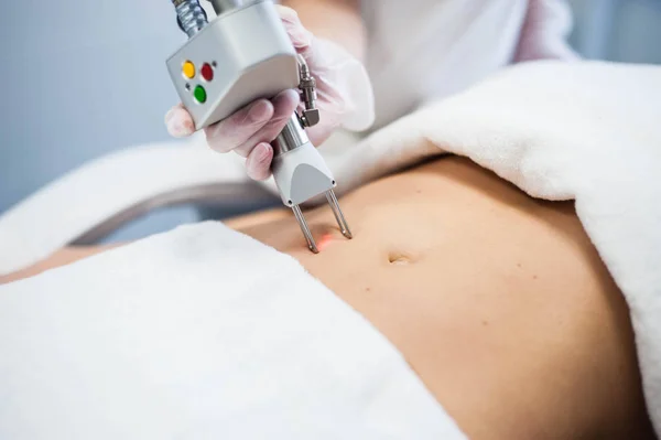 The doctor makes a laser correction of stretch marks on the stomach