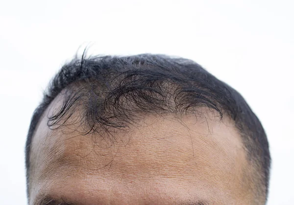 Выпадение Волос Передняя Сторона Человека Азиатского Происхождения — стоковое фото