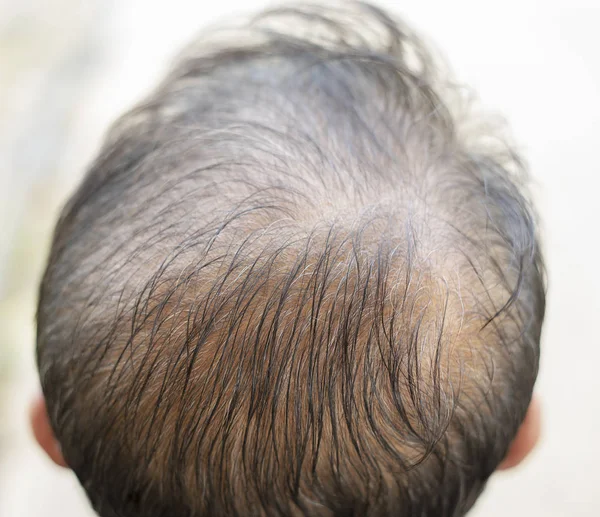 Hair loss top view of asia man — Stock Photo, Image