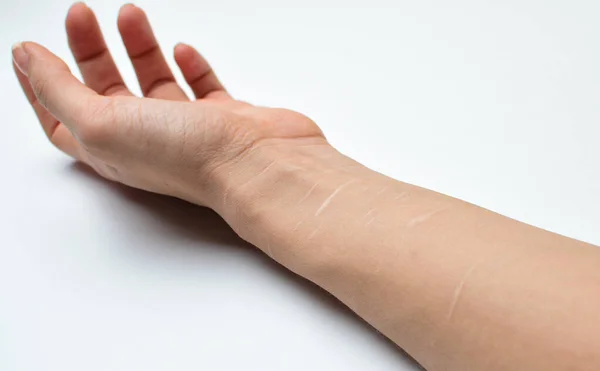 Female Hand Close Scars Veins — Stock Photo, Image