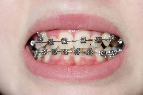 Orthodontic braces.  Close up. Macro — Stock Photo, Image