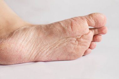 Kırık topukları yakınla. Ayaklarda cilt ile sağlık sorunları