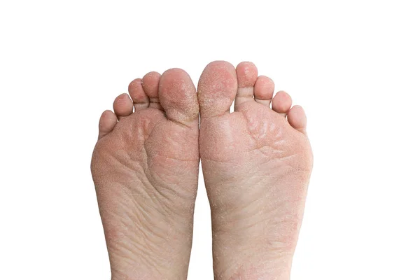 Zavři Prasklé Podpatky Zdravotní Problémy Pokožkou Nohou — Stock fotografie