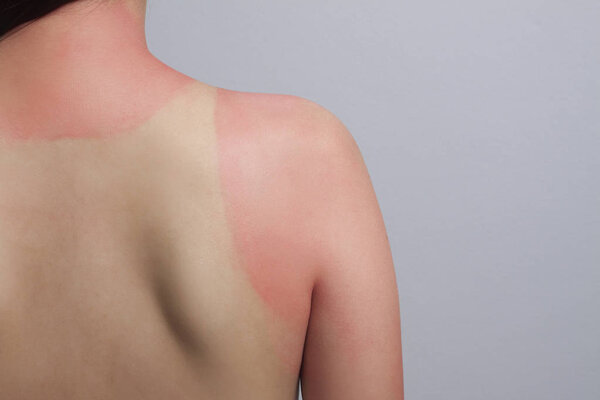 sunburn effect on skin