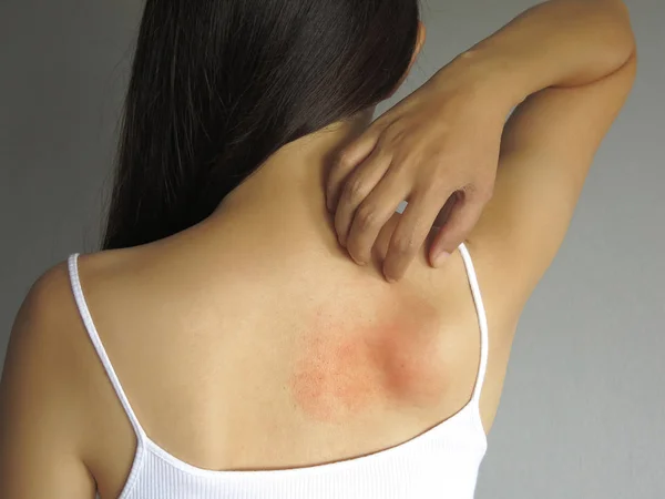 Alergia à saúde problema de cuidados da pele. Closeup jovem mulher coçando suas costas coceira com alergia erupção cutânea — Fotografia de Stock