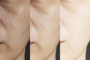 three pictures compared effect Before and After treatment. skin with problems of freckles , pore , dull skin and wrinkles before and after treatment to solve skin problem for better skin result clipart