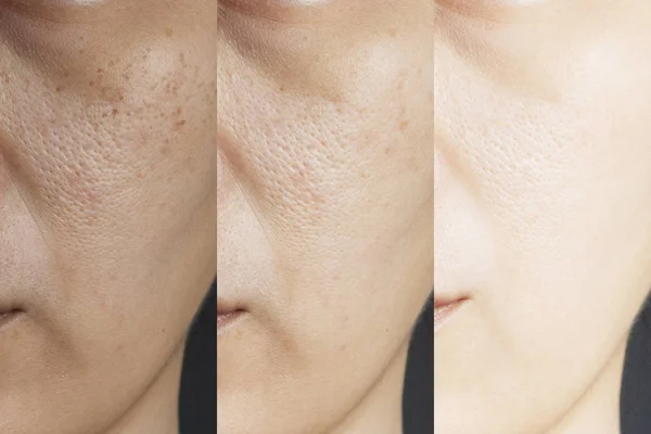 Three pictures compared effect Before and After treatment. skin with problems of freckles , pore , dull skin and wrinkles before and after treatment to solve skin problem for better skin result — Stock Photo, Image