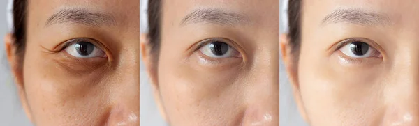 Trzy zdjęcia porównywały efekt przed i po leczeniu. pod oczami z problemami ciemnych kręgów, obrzęk i zmarszczki okołooczodołowe przed i po leczeniu w celu rozwiązania problemu skóry dla lepszej skóry — Zdjęcie stockowe