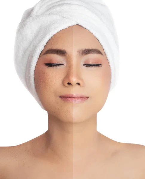前と後のレタッチそばかす そばかす色素スポットを除去し より良い肌のための皮膚の問題を解決するためにアジアの女性の顔にレーザー治療の前後に癒しを比較写真 — ストック写真