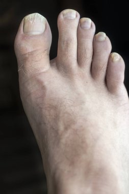 Asi ve kırık bacağı üzerinde çivi