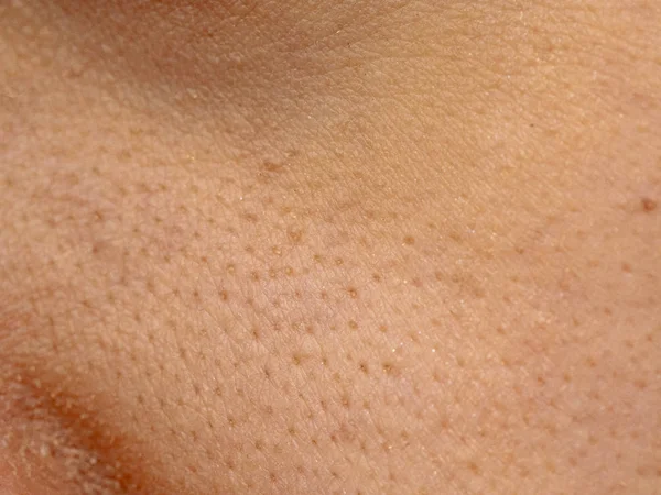 close up wide pores skin on dry face of Asian woman, Female nose and cheek skin problem, large pores, whitehead and blackhead pimple