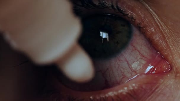 Vrouw die druppels voor de behandeling van conjunctivitis — Stockvideo