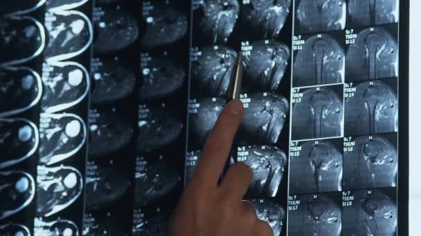 Dokter onderzoekt Mri schoudergewrichtsscan — Stockvideo