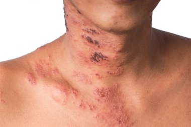 Herpes zoster veya Zingles veya Zoster; semptom Varicella Zoster virüsü veya VZV tarafından enfekte edilir. Yerel bir bölgede kabarcıkları olan acılı bir deri döküntüsüyle karakterize edilen viral bir hastalık. İsilik vücudun tek bir yerinde, geniş bir kaşıntıda ortaya çıkar.