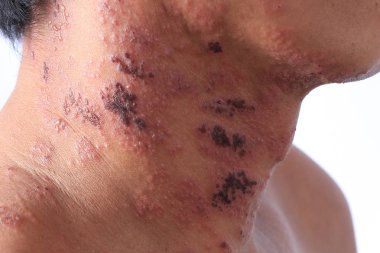 Herpes zoster or Shingles or Zoster; the symptom is infected by Varicella Zoster Virus or VZV.  is a viral disease characterized by a painful skin rash with blisters in a localized area. The rash occurs in a single part, wide itch side of the body clipart