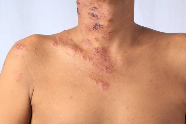 Herpes zoster veya Zingles veya Zoster; semptom Varicella Zoster virüsü veya VZV tarafından enfekte edilir. Yerel bir bölgede kabarcıkları olan acılı bir deri döküntüsüyle karakterize edilen viral bir hastalık. İsilik vücudun tek bir yerinde, geniş bir kaşıntıda ortaya çıkar.