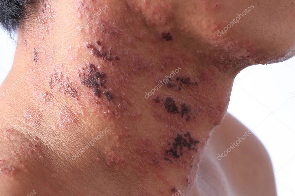 Herpes zoster or Shingles or Zoster; the symptom is infected by Varicella Zoster Virus or VZV.  is a viral disease characterized by a painful skin rash with blisters in a localized area. The rash occurs in a single part, wide itch side of the body