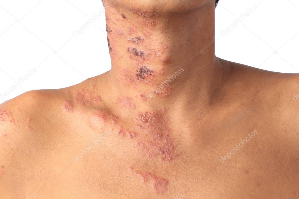 Herpes zoster or Shingles or Zoster; the symptom is infected by Varicella Zoster Virus or VZV.  is a viral disease characterized by a painful skin rash with blisters in a localized area. The rash occurs in a single part, wide itch side of the body