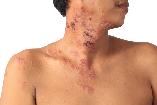 Herpes zoster veya Zingles veya Zoster; semptom Varicella Zoster virüsü veya VZV tarafından enfekte edilir. Yerel bir bölgede kabarcıkları olan acılı bir deri döküntüsüyle karakterize edilen viral bir hastalık. İsilik vücudun tek bir yerinde, geniş bir kaşıntıda ortaya çıkar.