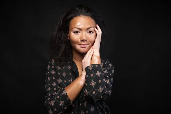 Cilt sorunları ile güzel Afrikalı kız. Vitiligo kavramı