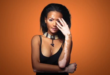 Beautiful African girl in studio with skin problems Vitiligo. studio shooting. On the terracotta color background with free space for your text clipart