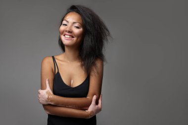 Studio cilt sorunları Vitiligo ile güzel Afrikalı kız. Stüdyo çekim. Koyu gri arka plan üzerinde