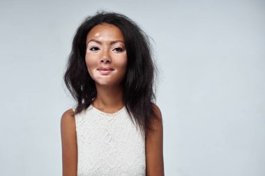 Studio cilt sorunları Vitiligo ile güzel Afrikalı kız. Stüdyo çekim. Beyaz arka plan üzerinde izole
