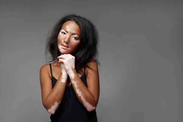 Schöne Afrikanische Mädchen Studio Mit Hautproblemen Vitiligo Studioaufnahmen Auf Dem — Stockfoto