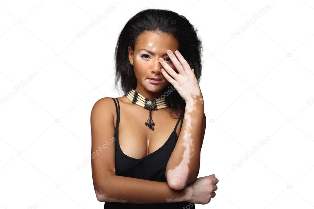 Beautiful African girl in studio with skin problems Vitiligo studio shooting
