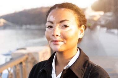 Vitiligo ile Afrika kökenli güzel bir genç kız sıcak bahar şehir caddesinde siyah ceket giymiş ayakta