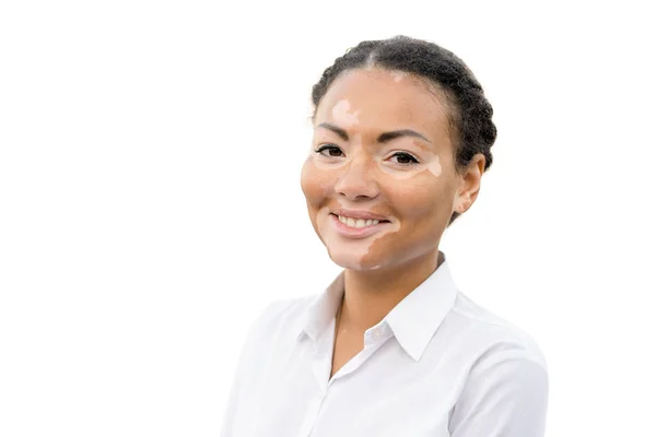 Vitiligo beyaz arka plan üzerinde izole Afrika etnik güzel bir genç kız