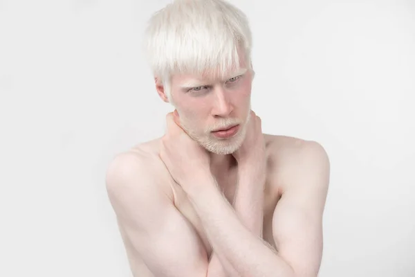 Портрет альбиноса в студии, одетого в футболку, изолированную на белом фоне. аномальные отклонения. необычный внешний вид — стоковое фото