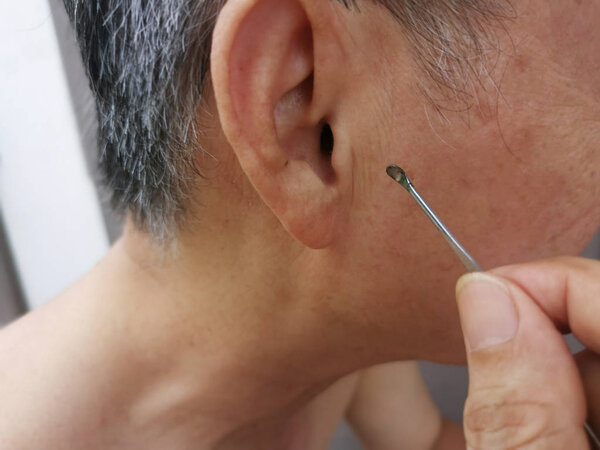 man using cleaning kit to his inner ear wax