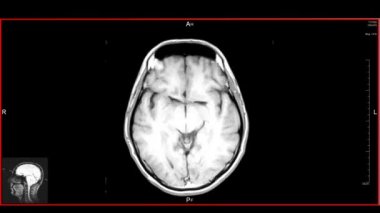 Beyin üst Mrt taraması. Diagnostik Tıbbi Araç (döngü)