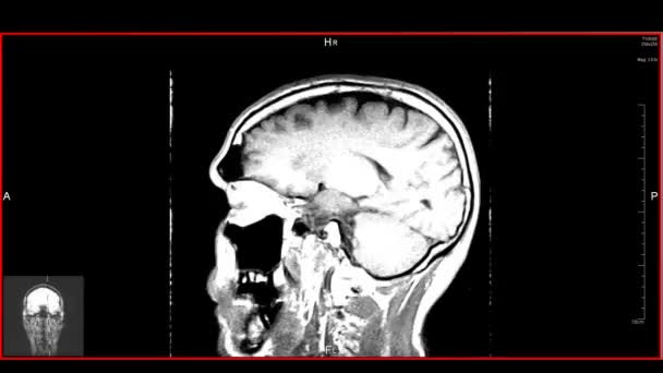Mózg Szczyt Mrt Skandować Diagnostyczne Narzędzie Medyczne Pętla — Wideo stockowe