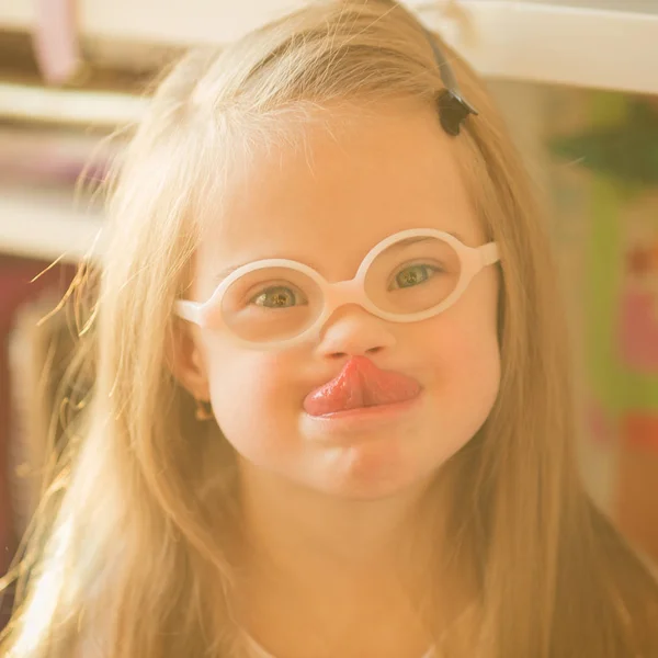 Retrato Una Niña Con Síndrome — Foto de Stock