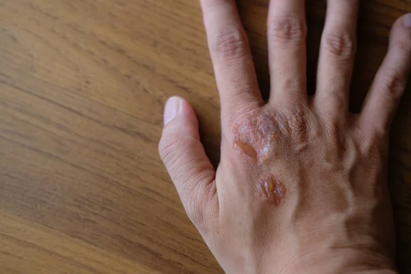 Psoríase Vulgar Fungo Eczema Mão Feminina Com Pus Erupção Cutânea — Fotografia de Stock