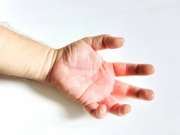 手和手指肌腱炎 办公室综合征 — 图库照片