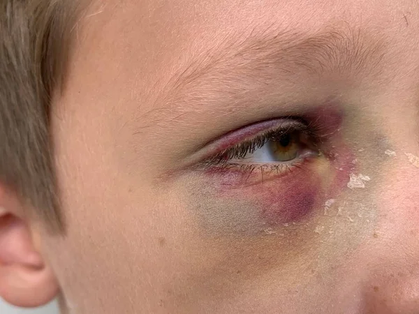 Bruise on the eye of a boy, close-up. A tumor under the eye of a teenager. Blue discoloration and himatoma on the face of a child. Concept: head trauma, bodily injury.