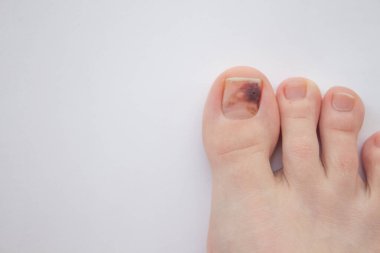 Rahatsız ayakkabılar giydiği için tırnağa darbe almış. Ayak tırnağındaki hematom tedavisi. Tıp konsepti