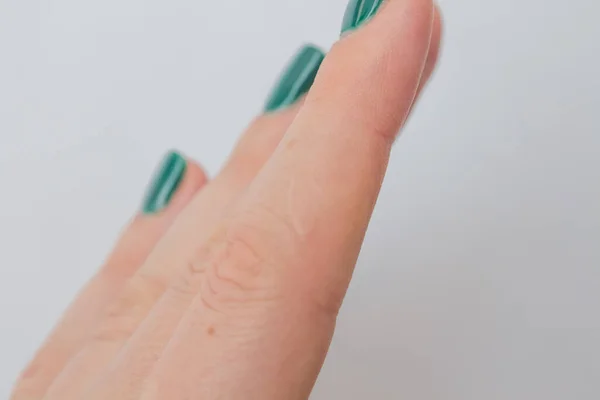 Feche Mão Feminina Com Uma Cicatriz Queimadura Curada Conceitos Saúde — Fotografia de Stock