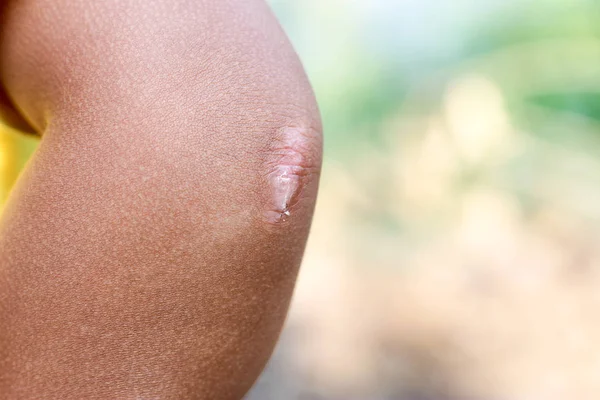 Scar on the elbow of the child. — Stock Photo, Image