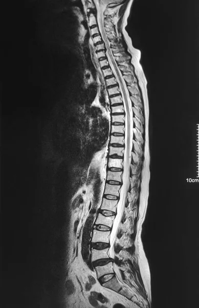 Ray Mri Lumbosacral Spine Case Low Back Pain Preoperatively Evaluate — Stock Photo, Image