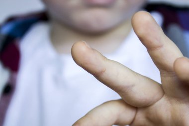 Wart, Childs 'ın parmağında papilloma. Ciltte dermatolojik sorunlar var. Bir çocuğun ellerinde ve parmaklarında Papillomavirus var. Pediatrik dermatoloji. Deri hastalıkları.