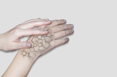 Hand with cracked skin. Cracked skin, dry skin. Skin care in winter, moisturizing the skin clipart
